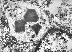 F, 35y. | crystalline inclusions in plasmocyte F, 35y. | crystalline inclusions in plasmocyte